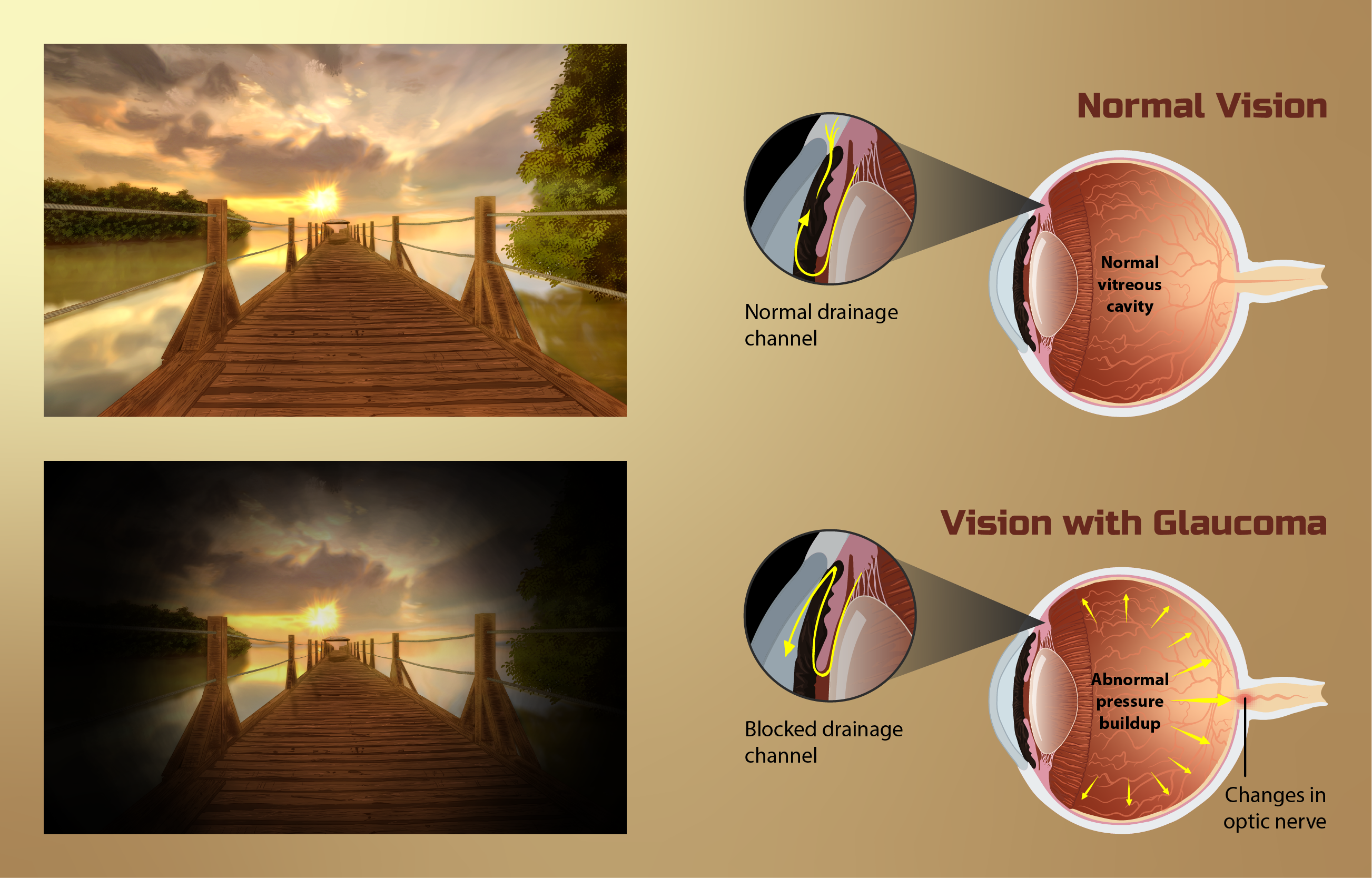Depiction of vision for a Glaucoma patient. The typical pathophysiology associated with Glaucoma has been shown as well (blocked drainage channel in the eye and changes in the optic nerve).