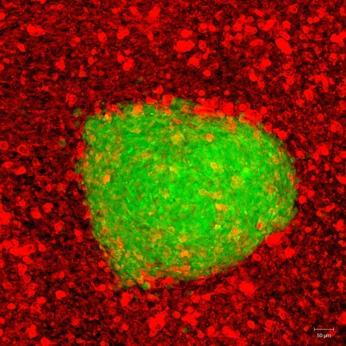 A human brain tumor mass (green) that has been engrafted into and is actively growing within a rat brain slice explant. The red immunostaining shows the resident microglial immune cells of the rat brain tissue starting to gather at the margins of the tumor.

Credit: Bijal Shah and Linda Kaltenbach, Ph.D., Duke University