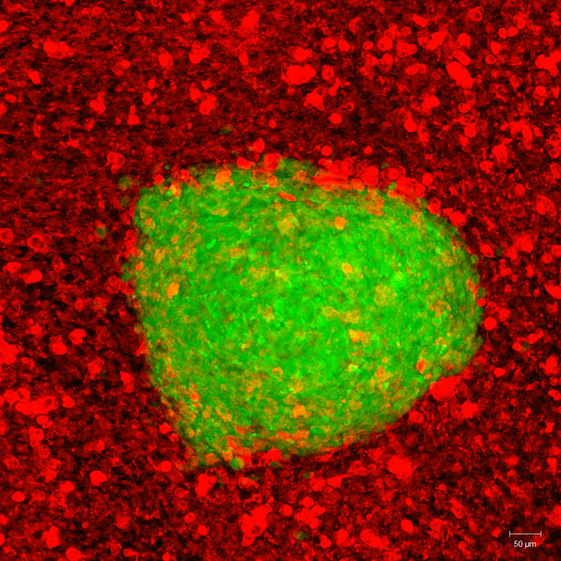A human brain tumor mass (green) that has been engrafted into and is actively growing within a rat brain slice explant. The red immunostaining shows the resident microglial immune cells of the rat brain tissue starting to gather at the margins of the tumor.

Credit: Bijal Shah and Linda Kaltenbach, Ph.D., Duke University