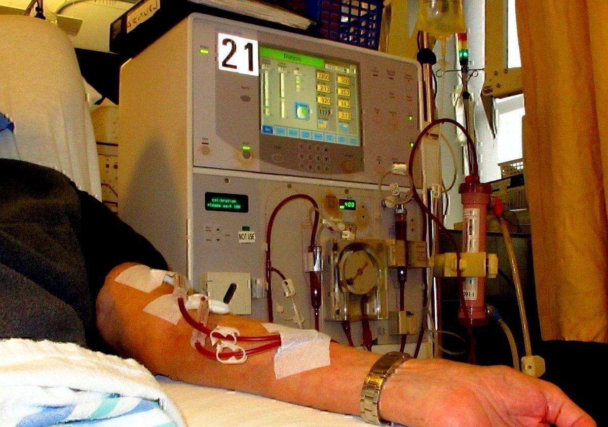 Arm of patient receiving dialysis.
