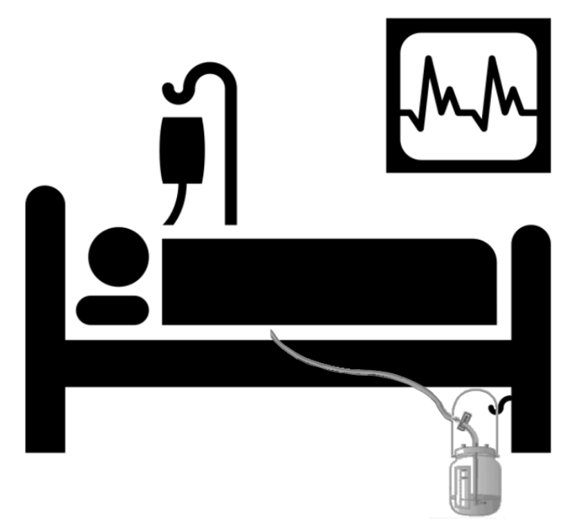 Por favor, quando possível, sempre manter o frasco de drenagem pleural, pendurado próximo ao pé da cama. Deste modo se evita a formação de sifão no tubo de drenagem que impede a correta evacuação do pneumotórax (fuga aérea - fístula aérea).