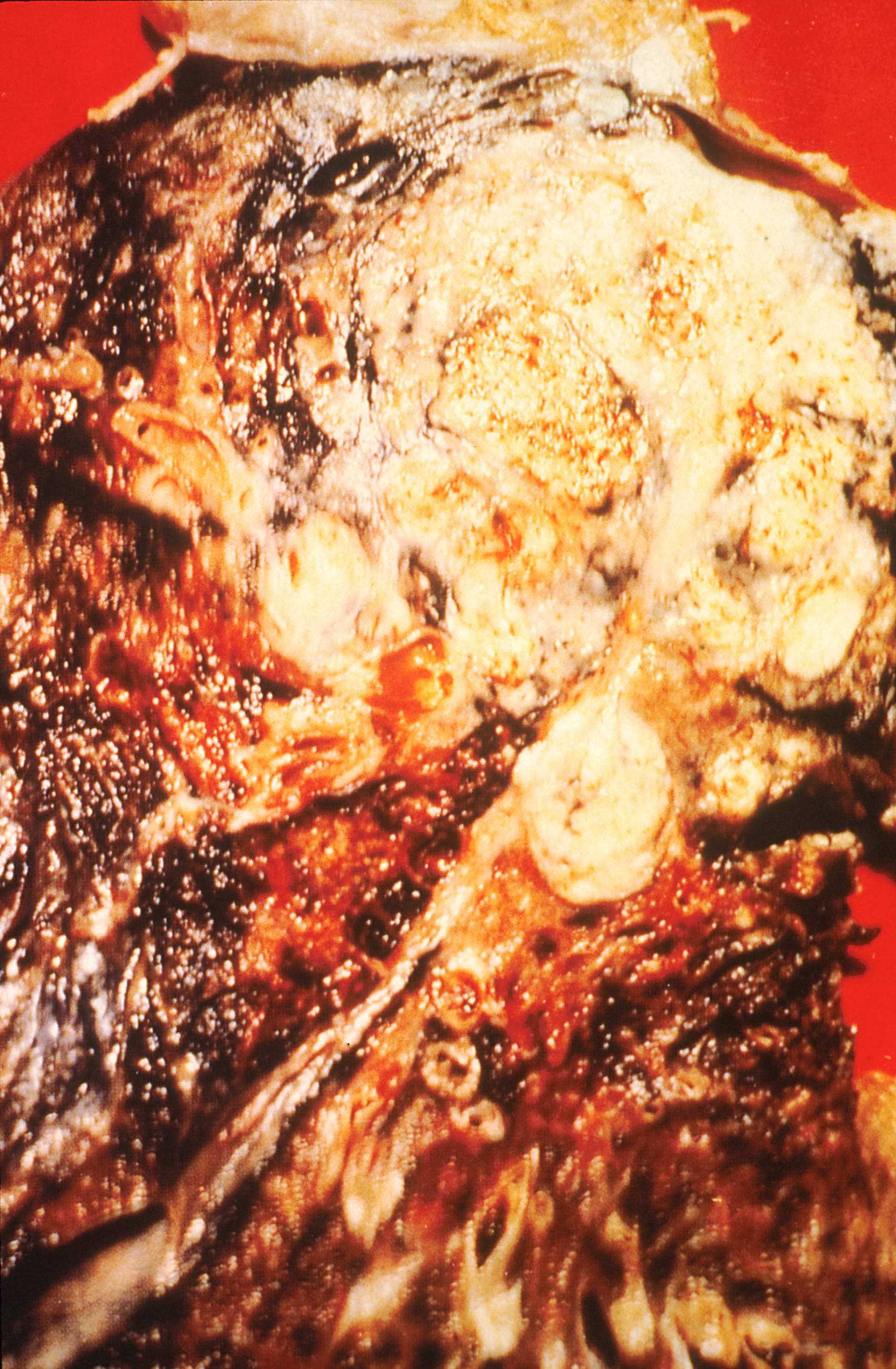 Title Pathology of the Lung (Cancer)
Description Cross section of a human lung. The white area in the upper lobe is cancer, the black areas indicate the patient was a smoker.
Topics/Categories  Anatomy -- Respiratory/Thoracic System Cancer Types -- Lung Cancer  Cells or Tissue -- Abnormal Cells or Tissue
Type Color, Photo
Source National Cancer Institute