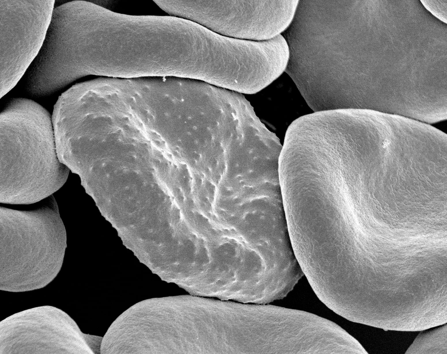 Electron micrograph of red blood cells infected with Plasmodium falciparum, the parasite that causes malaria in humans. During its development, the parasite forms protrusions called 'knobs' on the surface of its host red blood cell which enable it to avoid destruction and cause inflammation. Using scanning electron microscopy, this image shows a knob-rich infected blood cell surrounded by knobless uninfected blood cells.